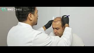 زراعة الشعر تركيا 2022 - BMS Clinics