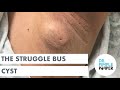 The Struggle Bus Cyst
