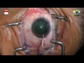 Cataract surgery  katarata pagtitistis 1155
