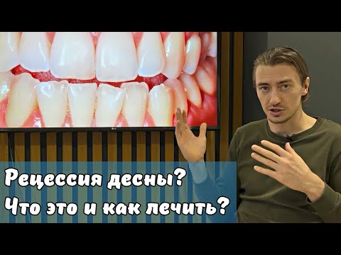 Dental Stories // Рецессия десны: что это и как это лечить? Рассказываю на примере моего пациента