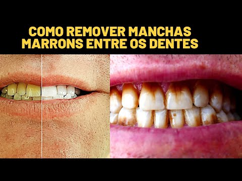 Vídeo: 3 maneiras de remover manchas marrons dos dentes