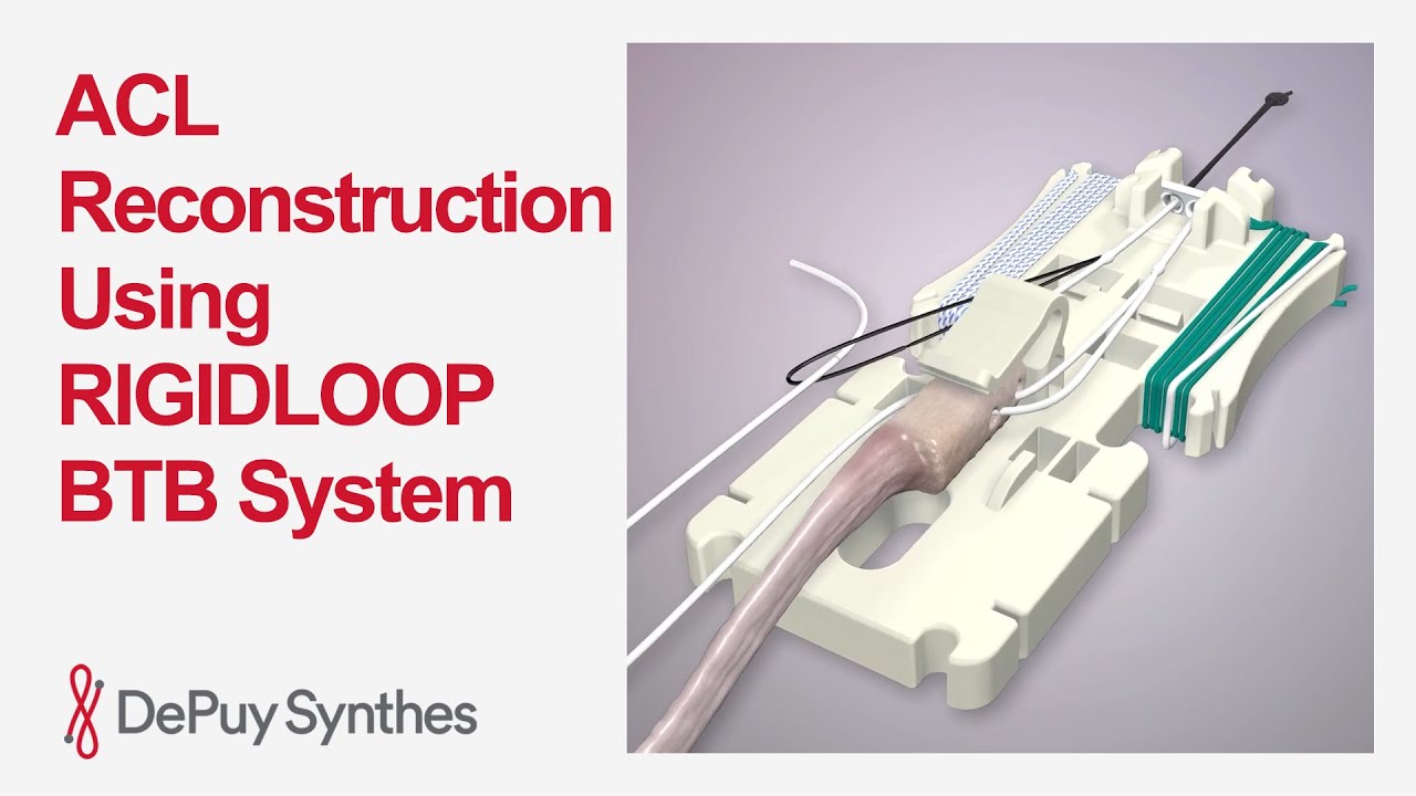 How to Use the RIGIDLOOP BTB Adjustable Cortical System in ACL Reconstruction | DePuy Synthes