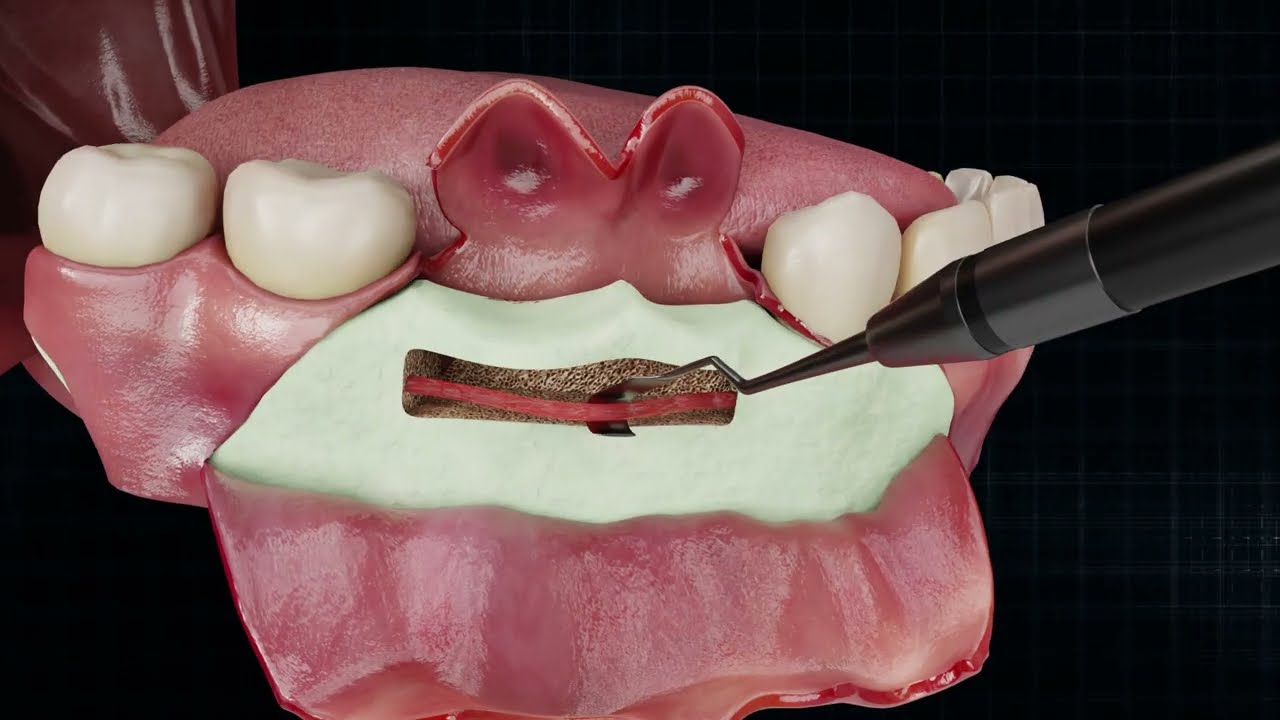 Precision Dental Care: 3D Animation of Tooth Implant Surgery