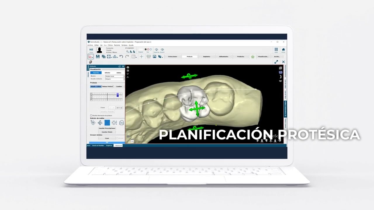 Demo NemoScan - El mayor avance en implantología digital_Español