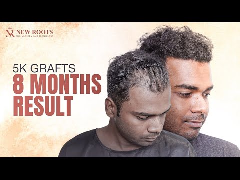“Thank You New Roots for My New Hair!” 😍 | 5000 Grafts | Hair Transplant Cost and Results in Kolkata