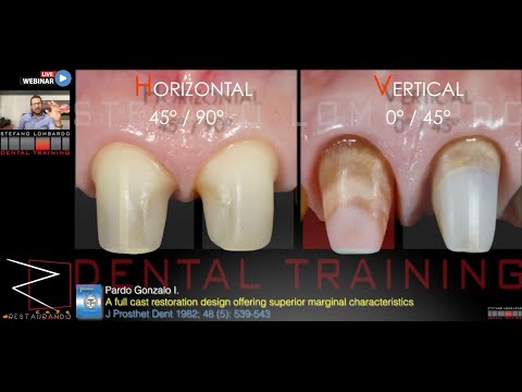 Video: La copertura dentale delta si ribasatura della protesi?