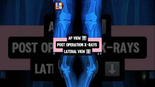 Total Knee Replacement #knee #arthritis #ytshorts #doctor #ortho #surgery #trend #pain #gkp #trust