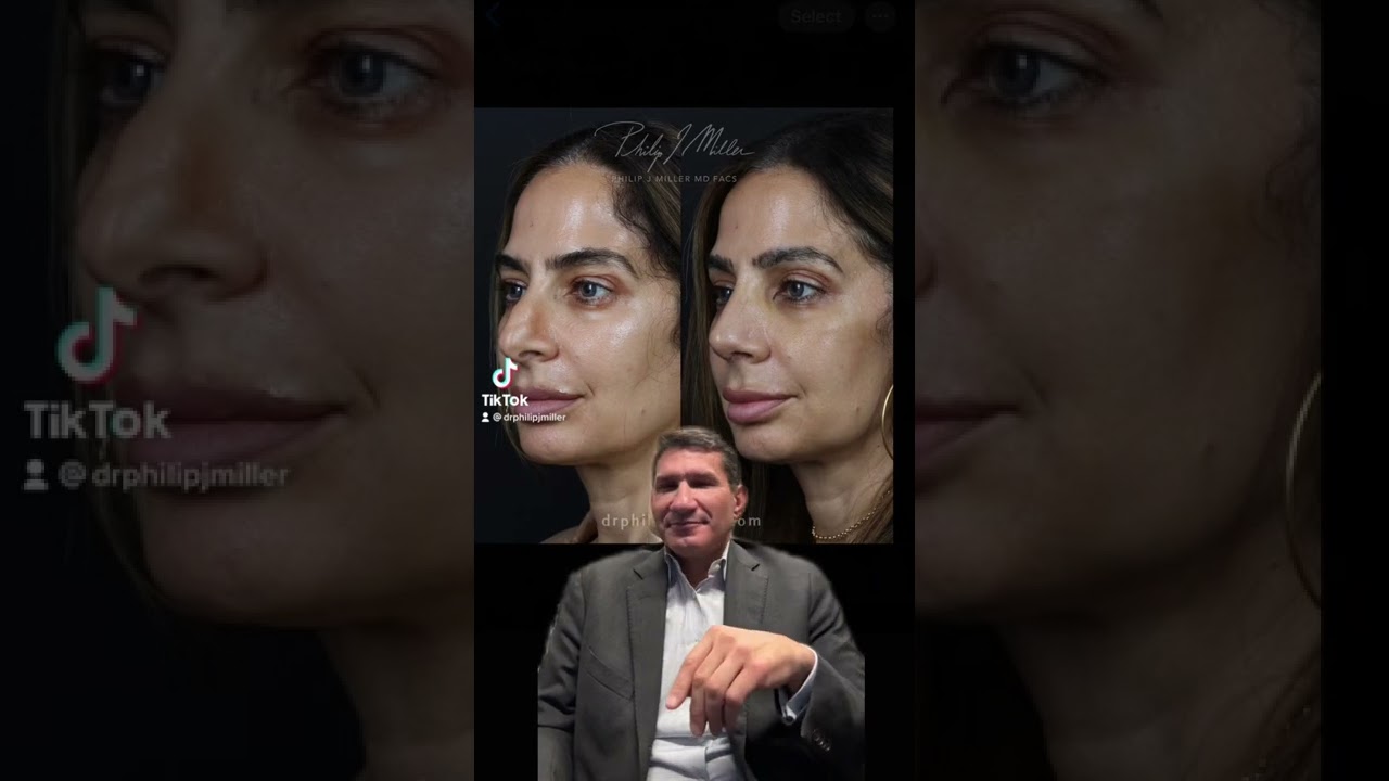 Life-Changing Rhinoplasty Results! What An Amazing Transformation!