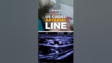 Ultrasound-Guided Arterial Line #ultrasound #arterial #nysora
