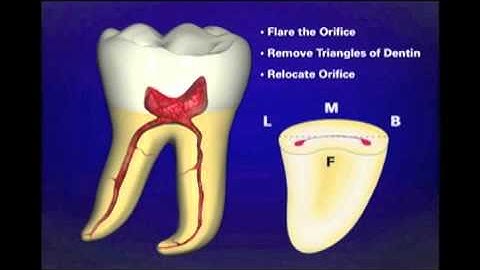 Dr. Ruddle on Access Preparation | Dentsply Sirona