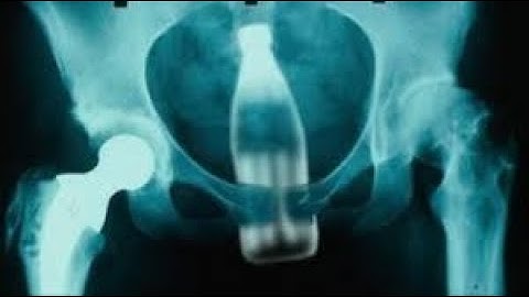 Removal of foreign body with Anoscopy CPT code - simplify medical coding