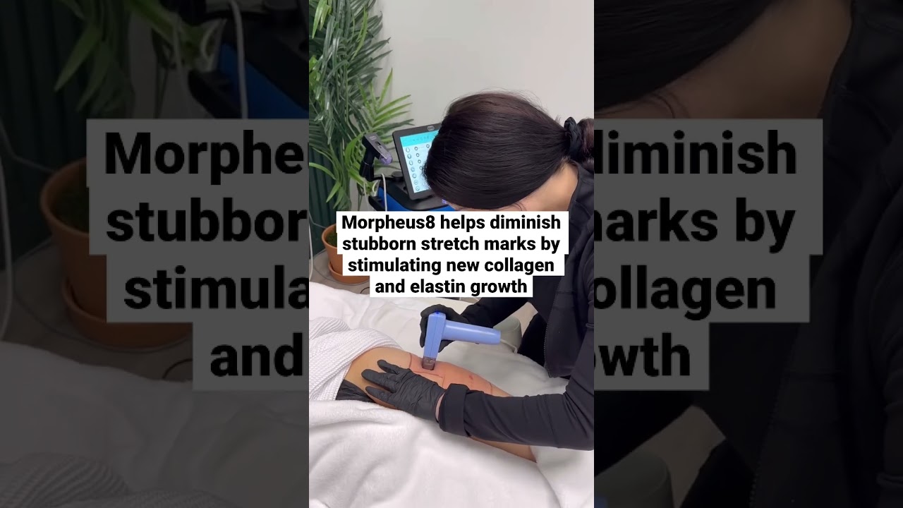 Reduce stretch marks with Morpheus8 