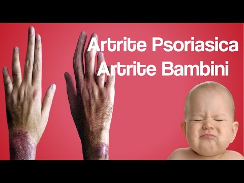 artrite-psoriasica,-artrite-bambini,-artrite-e-artrosi,-artrite-idiopatica-giovanile-cura