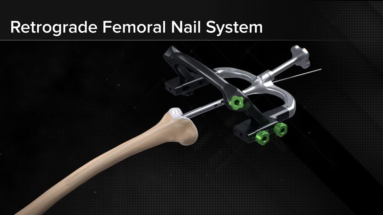 Share more than 144 3 point fixation nail