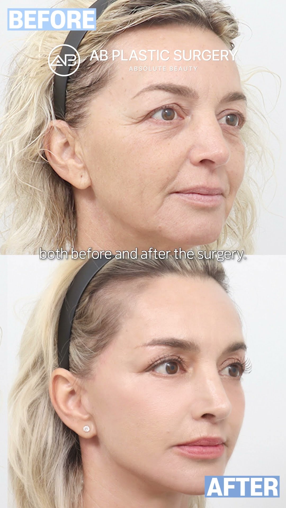 Best Age for a Facelift? Shocking Truth! #shorts