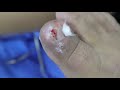 Ep_632 Ingrown nail removal 👣 เอาออก 1 ชิ้น มีขบอยู่ด้านในอีก 😣(This video clip from thailand)