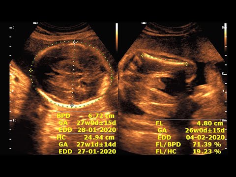 Ultrasound cases 75 of 2000 ||Video Showing About 35 wks single viable pregnancy