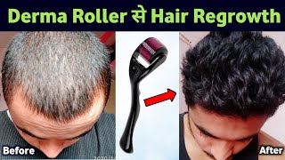 Dermaroller की सच्चाई | Derma roller for hair regrowth | My 6 months result
