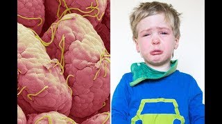 Thread Worm, پیٹ کے کیڑے Treatment In Homeopathic