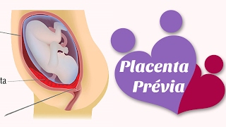 Placenta prévia