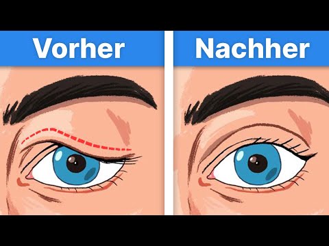 Video: 5 Häufige Laufprobleme Und Deren Behebung