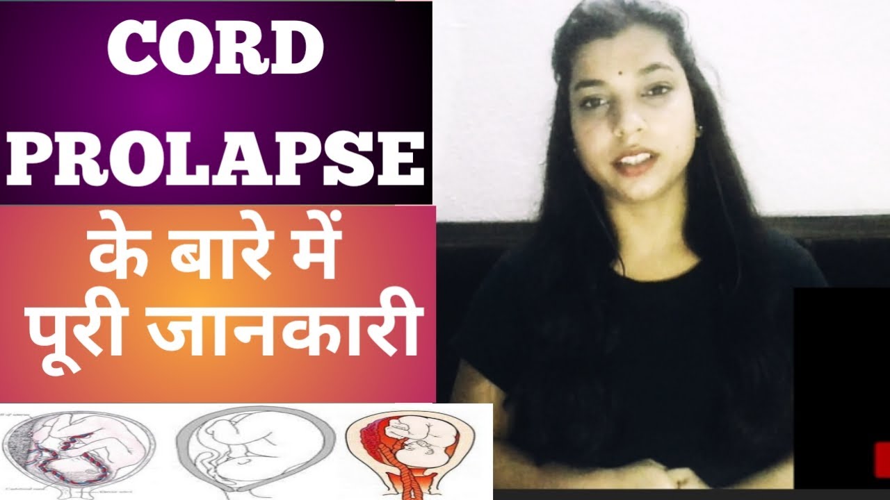Cord Prolapse cord Prolapse management prolapse cord cord Prolapse lacture cordprolapse