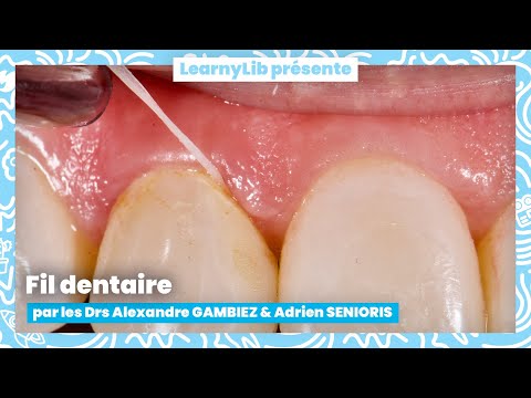 Vidéo: 4 façons de passer la soie dentaire avec des accolades