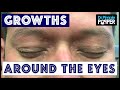 Removing Multiple Different Types of Growths around Eyes