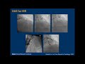 Coronary Atherectomy: Tips and Tricks - Sunil Rao, MD