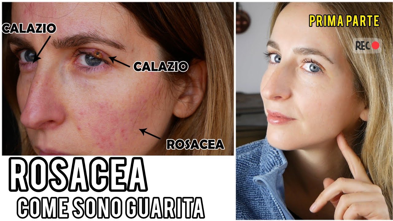 Così ho sconfitto la rosacea (dopo 12 anni)