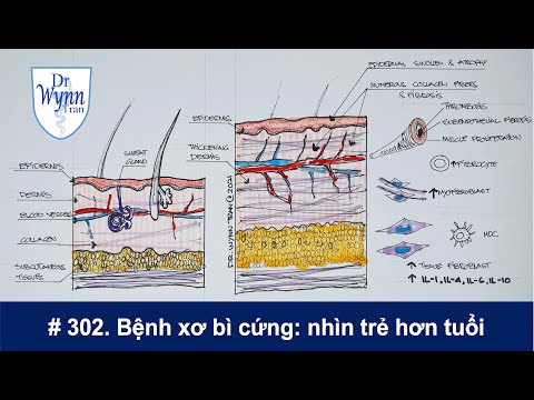 #302. Bệnh xơ bì cứng (Scleroderma): luôn nhìn trẻ hơn tuổi và cần Viagra mỗi ngày