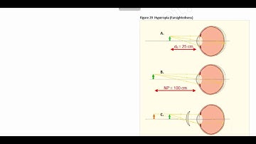 OAT: Optics Finding Focal Length and Refractive Power (Correcting Nearsightedness)