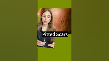 Real Facts About Acne Scars #dermatologist