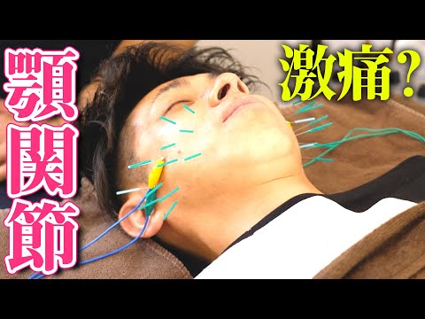 激痛？顎関節症の治療。鍼と電気を使うプロの技を体験しました！【小顔王子】