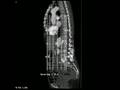 Radiology Rounds @ radRounds - Malrotated Right Kidney