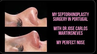 Nose surgery vlog Pt1 Septorhinoplasty  - @josecarlosmartinsneves #nosejob #nosesurgery #rhinoplasty