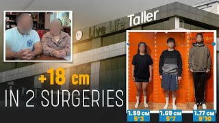 +18 CM IN 2 LIMB LENGTHENING SURGERIES | 1.59 M to 1.69 M to 1.77 m