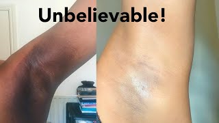How I Transformed My Dark Armpits Fast Ingrown Hairs Kojie San Lightening Soap