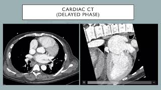 The Stunning Left Atrial Appendage