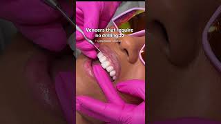 No prep veneers are ultra-thin porcelain veneers that require little to no drilling or removal of