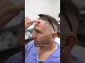 Let’s design the ideal hairline for this patient.