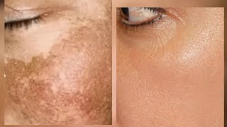 In 3 Days Get Rid of Hyperpigmentation,dark spots, acne scars and blemishes (Home Made Solution)