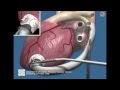 Jarvik 2000 evolution of surgical implantation from conventional to minimally invasive technique