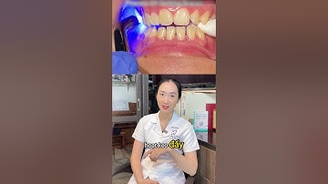 Quá trình gắn mắc cài lên răng #nhakhoaquocteachau #dentist #nhakhoauytin