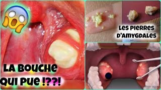 LA BOUCHE QUI PUE| Les pierres d'amygdales | COMMENT S'EN ...