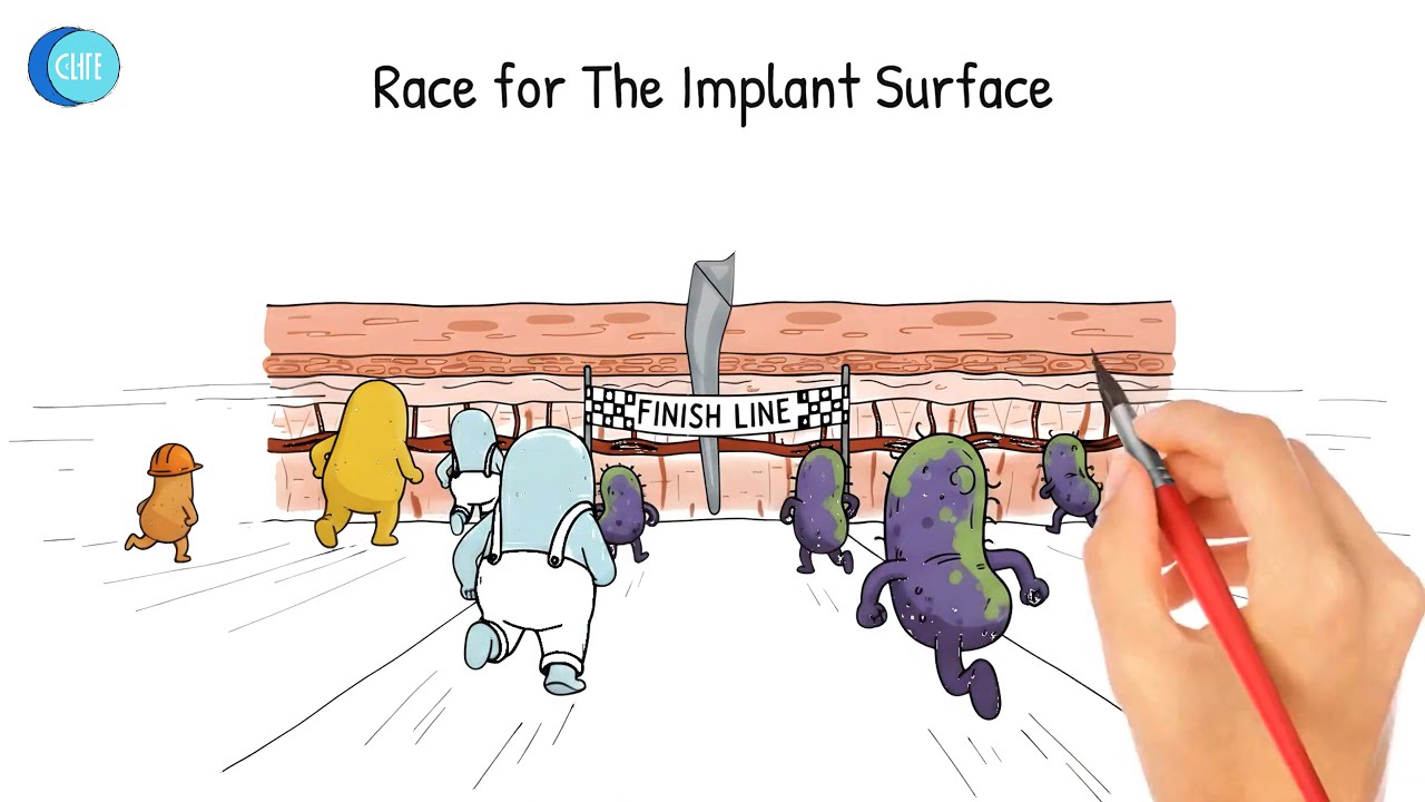 Implant Failure Explained: The Critical "Race for The Surface"