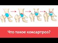 Что такое коксартроз?