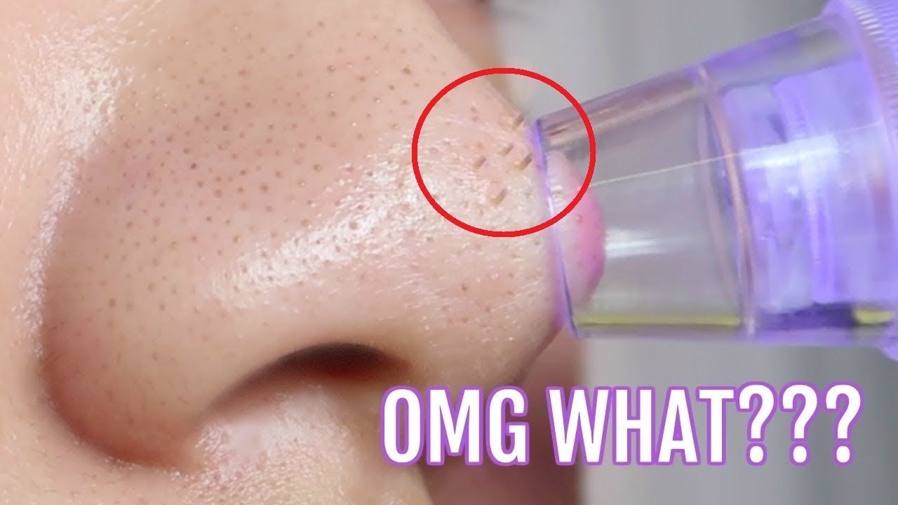 Best Ways To Remove Blackheads From Your Nose Youtube