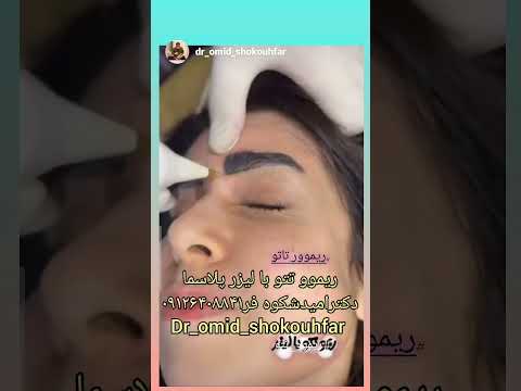 ریموو تتو تتو خالکوبی هاشور فیبروز ابرو ابرو زیبایی لیزر پلاسما