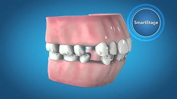 Invisalign G6 Innovations for First Premolar Extraction